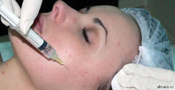 Лечение угревой сыпи на лице, на спине
